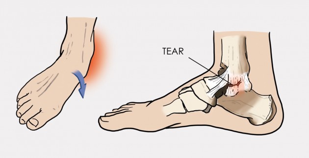 tipuri de leziuni la gleznă medicament articular al piciorului pentru vârstnici