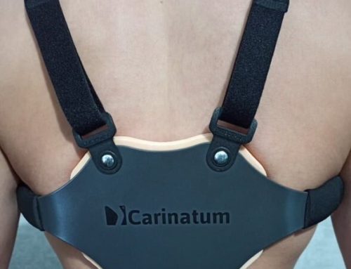 PECTUS CARINATUM